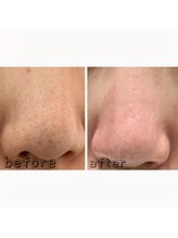 エクスクラメーションマーク(!!!)/ハイドラフェイシャル★