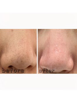 エクスクラメーションマーク(!!!)/ハイドラフェイシャル★