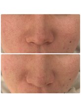 メゾンリュバン 梅田店(Maison Ruban)/毛穴洗浄・美白フォト|毛穴ケア