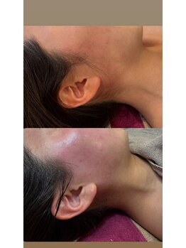 ジュエルオーキッド(Jewel orchids)/wax脱毛