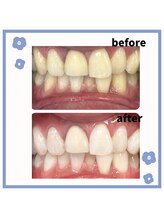 歯のホワイトニング専門店/【浦安】ホワイトニング