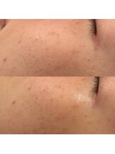 アール(ar.)/プラズマ顔脱毛（2回）