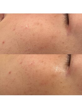 アール(ar.)/プラズマ顔脱毛（2回）