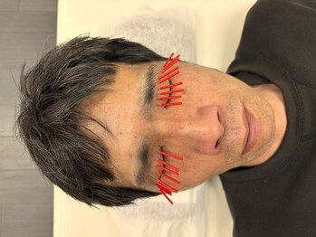 とだ鍼灸院/上まぶたのたるみ集中・改善◎