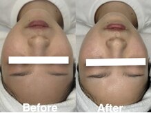 ハウピア(Haupia)/プラズマビフォーアフター