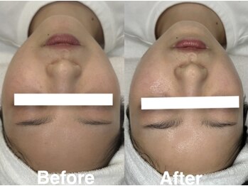 ハウピア(Haupia)/プラズマビフォーアフター