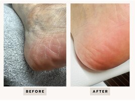 足裏角質&タコ集中ケアコース