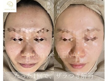 サロンドレナ 名駅店/ハーブピーリング サロンドレナ