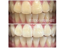 ホワイトニングルーム 横浜店(Whitening Room)/セルフホワイトニング/横浜