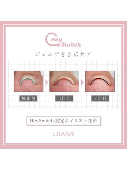 巻き爪ケアをするならここで！