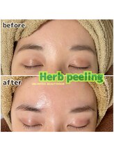 アンリミテッド ビューティールーム(UNLIMITED BEAUTYROOM)/-ハーブピーリング-