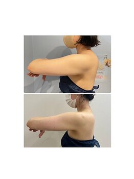 ルナグランデ 心斎橋店(Luna grande.)/二の腕引き締めお任せください