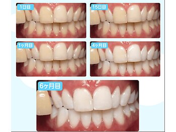 サラモ(Sa La Mo)/セルフホワイトニングで笑顔を♪