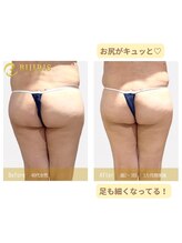 キングスサロン 熊本/四角いお尻さよなら！！！