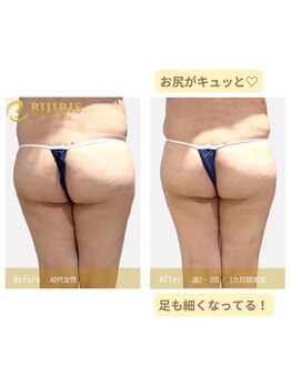 キングスサロン 熊本/四角いお尻さよなら！！！