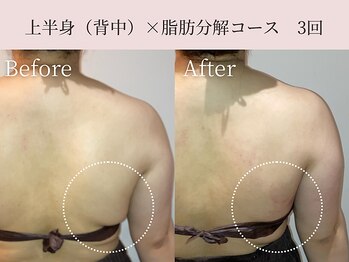ミア(miiia)/上半身×脂肪分解コース 3回