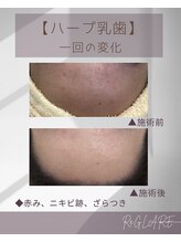 リグレア 浦安(Re.GLARE)/ニキビ、ざらつき