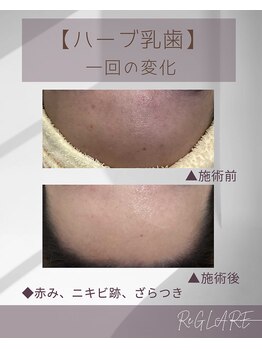 リグレア 浦安(Re.GLARE)/ニキビ、ざらつき