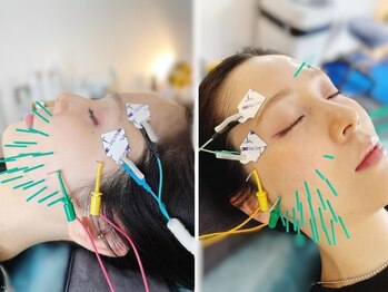 アオヤマ サロン ワイゼット(AOYAMA SALON YZ)の写真/【小顔になりたい方へ】むくみ・フェイスラインをすっきり整えるEMS美容鍼
