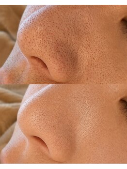 アマテラススキンラウンジ(Amatelas SKIN LOUNGE)の写真/毛穴レスな陶器肌へ◇もうお肌の事で悩まない感動素肌に導く◇毛穴／ニキビ／たるみ／くすみ／乾燥同時ケア