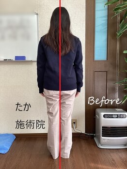 たか施術院/首 肩こり 美姿勢 初回施術前