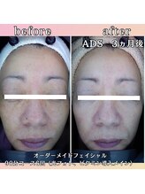 プリマジュール/「くすみ」「シミ」改善