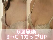 ヒヨコ 池袋西口店(Hiyoko)/バストアップ/育乳(施術10回)