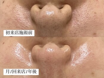 グラン ジュテ/1年間、月1回の施術