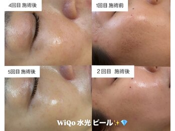 ウィ アネラ(U'i Anela)/WiQo 水光ピール