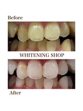 ホワイトニングショップ 妙高店(whiteningshop)/詰め物もホワイトニング可能！