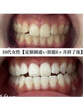 ホワイト 福岡天神店(WHITE)/ホワイトニングビフォーアフター