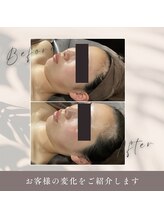 肌イズム 守谷店(肌ism)/【before&after】ララピール