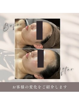 肌イズム 守谷店(肌ism)/【before&after】ララピール