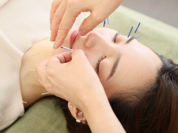 丸太町骨盤整骨院 鍼灸院の写真/美容も不調ケアもリラックスも.あなたに合わせた“オーダーメイド鍼灸”リフトアップや肌質改善には美容鍼