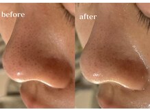 リスタ(RSTA)/【BEFORE/AFTER】