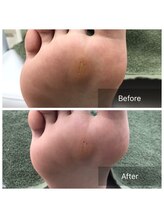 ドクターネイル爪革命 北千住店/たこ、うおのめケア　足湯あり