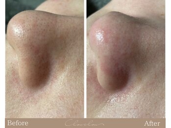 シュシュ(Chou chou)/【Before★After】毛穴