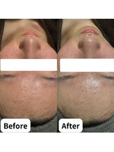 マヴィ(Mavie)/ハーブピーリング　Before After