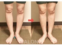 サロンアール(SALON R)/長年コンプレックスのO脚改善