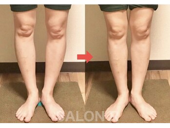サロンアール(SALON R)/長年コンプレックスのO脚改善