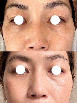 ハリーハリー 名古屋栄店(HARRY ハリー)/◆シミ改善◆