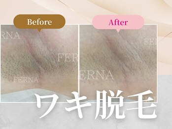 フェルナ(FERNA)/ワキ脱毛