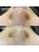 ルルラ リコ(lulula rico)/症例写真/ハイドラ毛穴洗浄