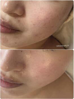 サロン エデンプラス(salon eden PLUS)/ニキビ肌荒れ改善