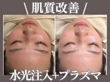 マヴィ 守口店(MavY.)/肌質改善しましょう！