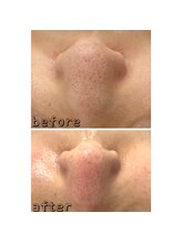 エクスクラメーションマーク(!!!)/ハイドラフェイシャル★