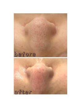 エクスクラメーションマーク(!!!)/ハイドラフェイシャル★