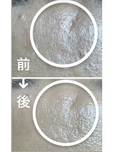 リンカ(Rinca)/毛穴は鼻だけじゃない！