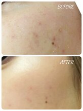 エタニティ 西宮店(Eternity)/韓国ハーブピーリング