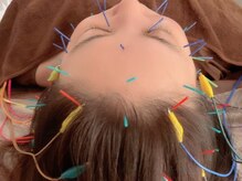 オン 蕨駅西口(ON)/美容鍼【しみシワ/たるみ改善】